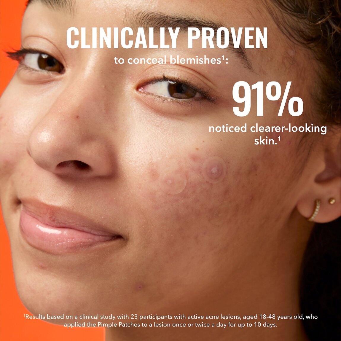 pimple-patches-b9 zb_p.jpg